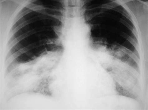 What is a chest x-ray for pneumonia? Advantages and disadvantages | Vinmec