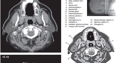 Ct Scan Soft Tissue Neck With Contrast - mapageprek