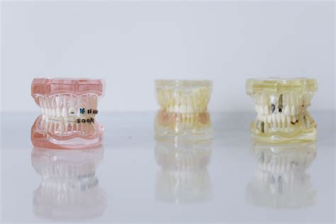 Orthodontics Newcastle - The Difference Between an Overjet and an Overbite? - The Dental Care ...