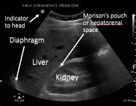 Finding Fluid: Morison's Pouch Finding Fluid