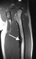 Osteoid Osteoma: Symptoms, Causes & Treatment | UCSF Radiology