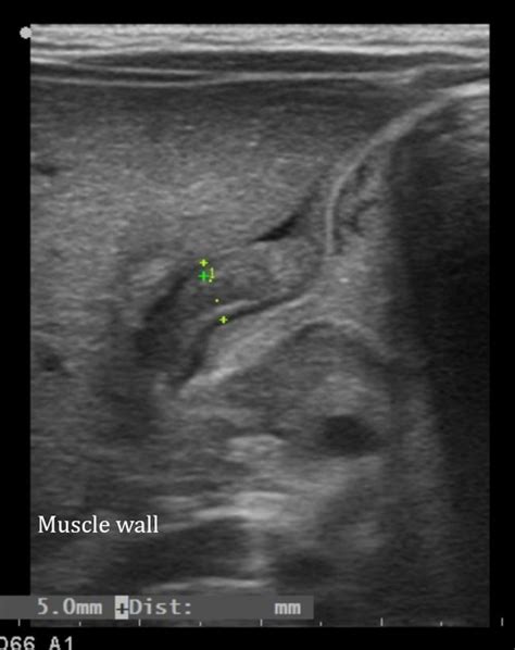 Pyloric Stenosis Ultrasound