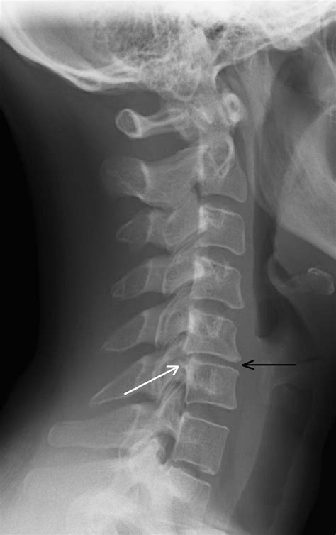 Cervical Degenerative Disc Disease | Neck Pain | Dr. Corenman