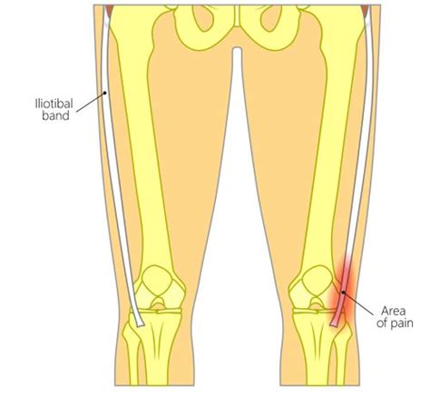 ITB Friction Syndrome - Get Active Physiotherapy