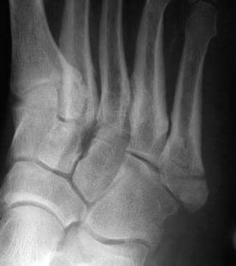 How are proximal avulsion foot fractures treated?