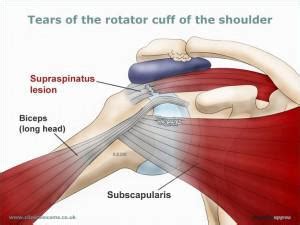 shoulder pain Archives - Eddie O'Grady Physiotherapist