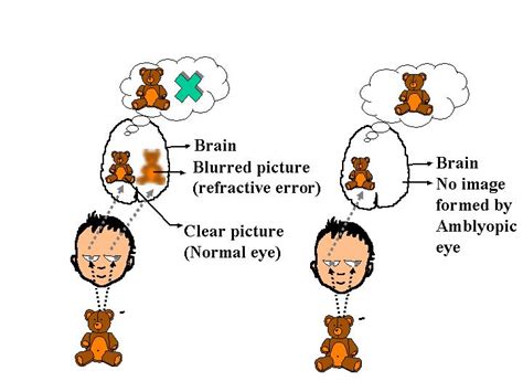 How to fix Lazy eye (Amblyopia)? - Evershine Optical