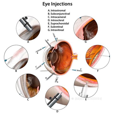 Intraocular injection sites and techniques, ophthalmic illustration