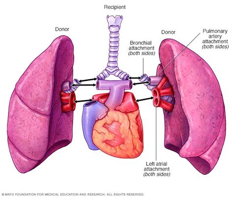 Lung transplant - Drugs.com