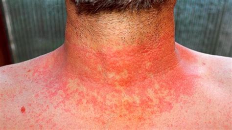 Autoimmune Skin Diseases and Rashes That Affect Appearance | Everyday Health