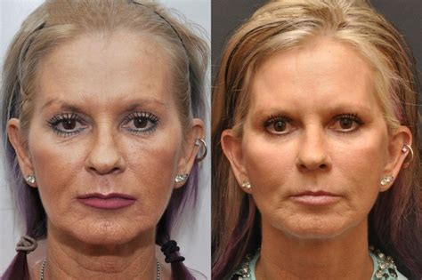 Minilift / Facelift Photos - Cincinnati Facial Plastic Surgery