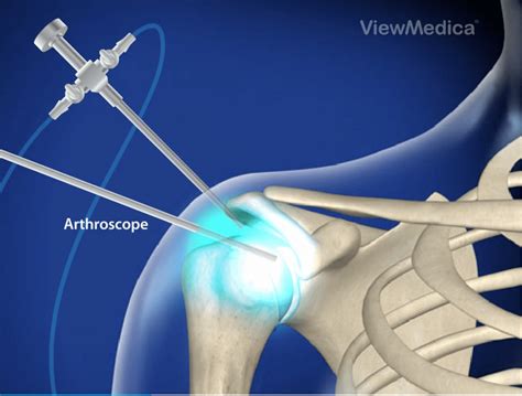 Diagnostic Arthroscopy - Florida Surgery Consultants