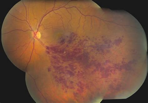 Retinal vein occlusion causes, symptoms, diagnosis, treatment & prognosis