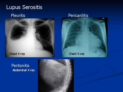 Case Report n A 44 yearold AfricanAmerican woman