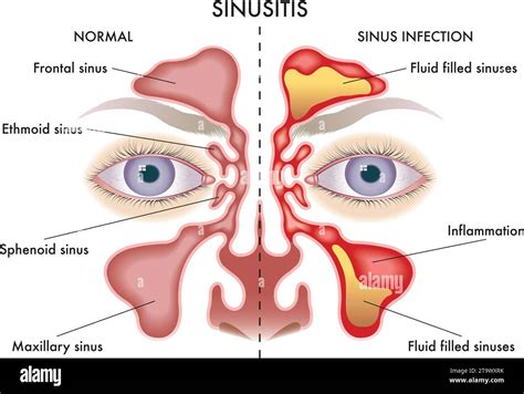 Medical illustration of symptoms of Sinusitis Stock Vector Image & Art ...