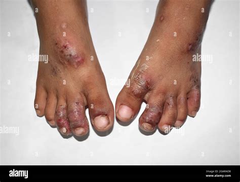 Scabies child feet hi-res stock photography and images - Alamy