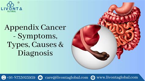 Appendix Cancer - Symptoms, Types, Causes & Diagnosis - Livonta Global Pvt Ltd