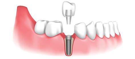 The Procedure For Getting A Dental Implant In Townsville - Cinque Restaurant