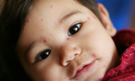 Chickenpox: Symptoms, Causes, And Treatment - Tata 1mg Capsules