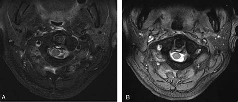 MRI revealed transverse ligament injury (arrow). (A) T1-weighted image ...