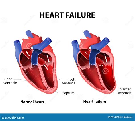 Heart Failure Stock Illustrations – 3,483 Heart Failure Stock ...