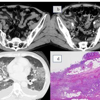 a Abdominal CT at initial examination: CT reveals an enlarged appendix ...