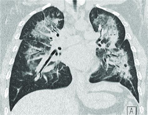 Computerized Tomography (CT) Scan of the Lungs. Consolidative patterns ...