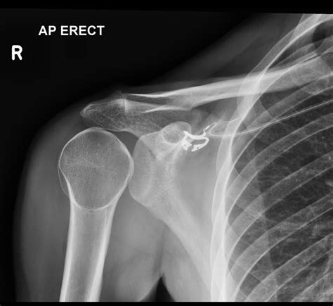 emDOCs.net – Emergency Medicine EducationEM@3AM: Posterior Shoulder ...