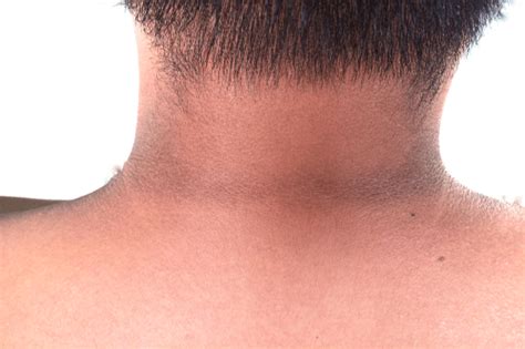 Acanthosis Nigricans:Facts, types, causes, remedies, & prevention| FactDr