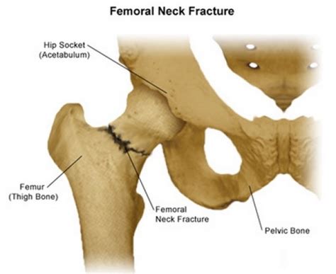 Femur Fracture Anatomy