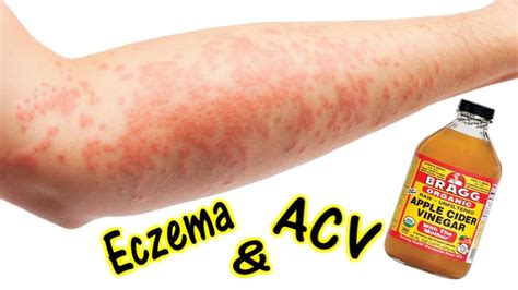 Apple Cider Vinegar For Eczema - All You Need Infos