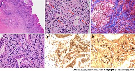 Hematoxylin and eosin stained. A: Low power hematoxylin and eosin (H&E ...