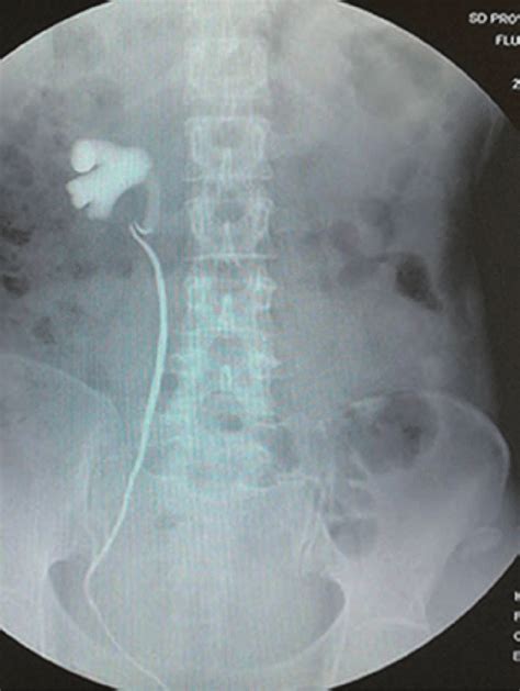 Retrograde urography image showed an obvious stenosis at the upper... | Download Scientific Diagram