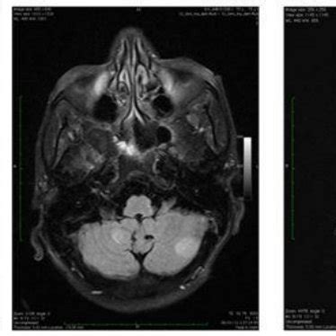 (PDF) Central pontine myelinolysis-A rare case report