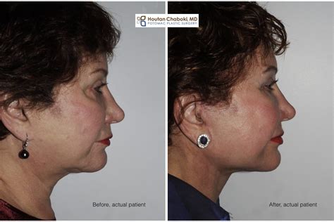 Neck lift vs. Facelift Cosmetic Surgery – Potomac Plastic Surgery