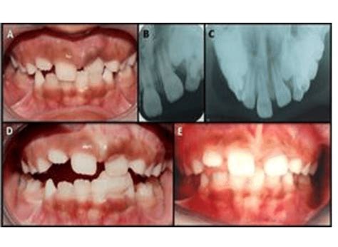 A. Intraoral photograph after extraction of triple teeth showing tooth ...