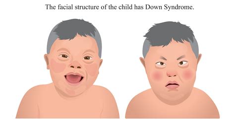 Down Syndrome: Symptoms, Causes, Prevention and Treatments