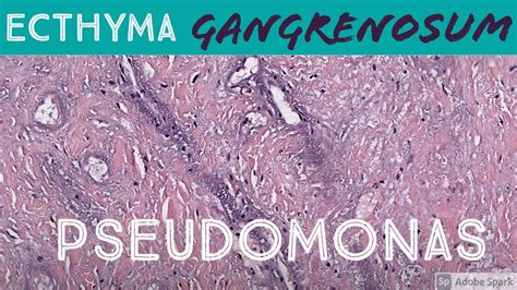 Ecthyma Gangrenosum (Pseudomonas aeruginosa) 5-Minute Pathology Pearls Dermatology ...
