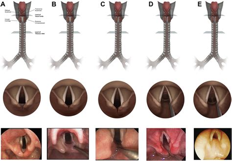 A 12-month-old With Dysphagia and Cough - The Journal for Nurse Practitioners