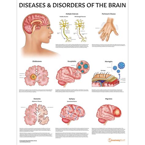 Brain Anatomy & Pathology Collection | Stroke Migraine Models Chart