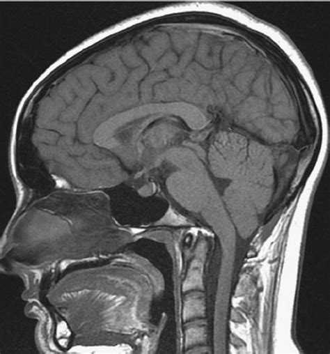 Platybasia in a 9-year-old child with no symptoms. The clivus – axis... | Download Scientific ...