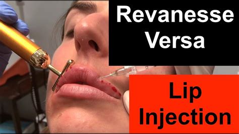 Revanesse Versa Lip Injection - NEW Hyaluronic Acid filler to US - YouTube