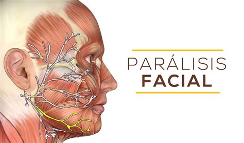 Parálisis facial – Clínica Pueyrredon