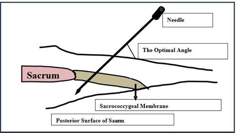 Caudal Block Technique | Download Scientific Diagram