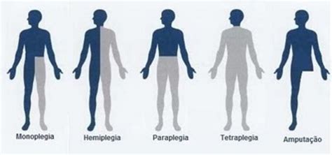 Types of Plegia...