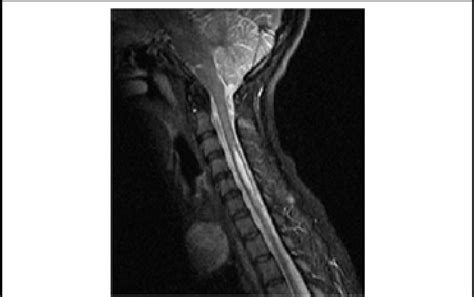 MrI (t2 sequence) of cervical spine showing syrinx from c4 to c7 level. | Download Scientific ...