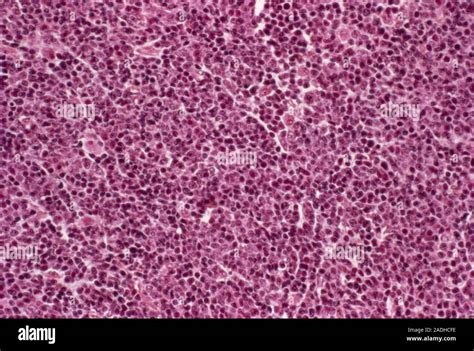 Lymphoma cancer. Light micrograph of a section through tissue from a ...