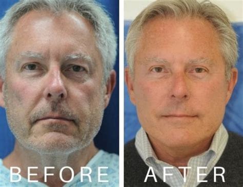 What Types of Facelift Surgery Are There for Men? | Beverly Hills Facelift Institute