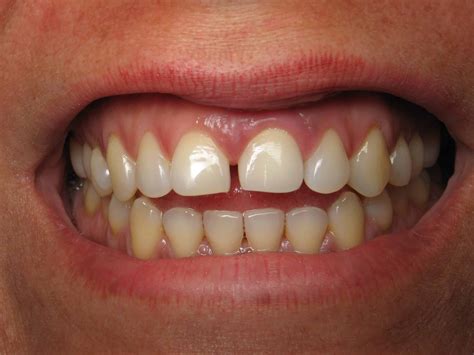 Keeping a Space Between Front Teeth –Bridge vs. Dental Implants