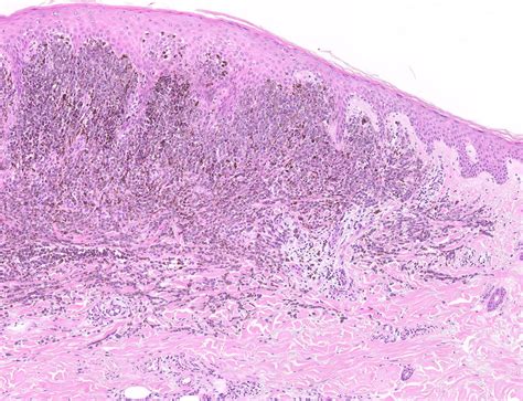 Invasive Melanoma Histology